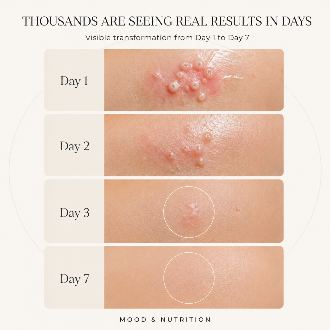 Hydrocolloid Patch Roll | Molluscum & Contagiosum Treatment